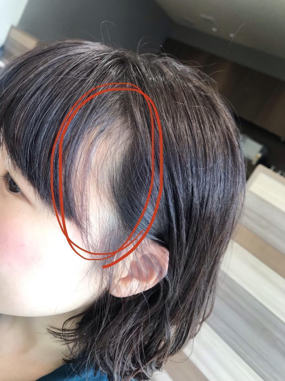 気になる前髪・生え際の「アレ」