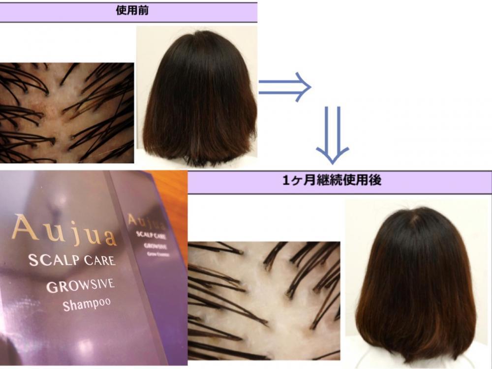 【GROWSIVE/グロウシブ　で白髪、抜け毛を解消！】