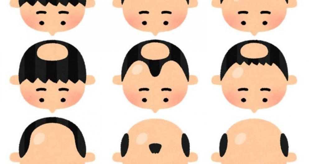 薄毛・抜け毛の原因①壮年性脱毛症