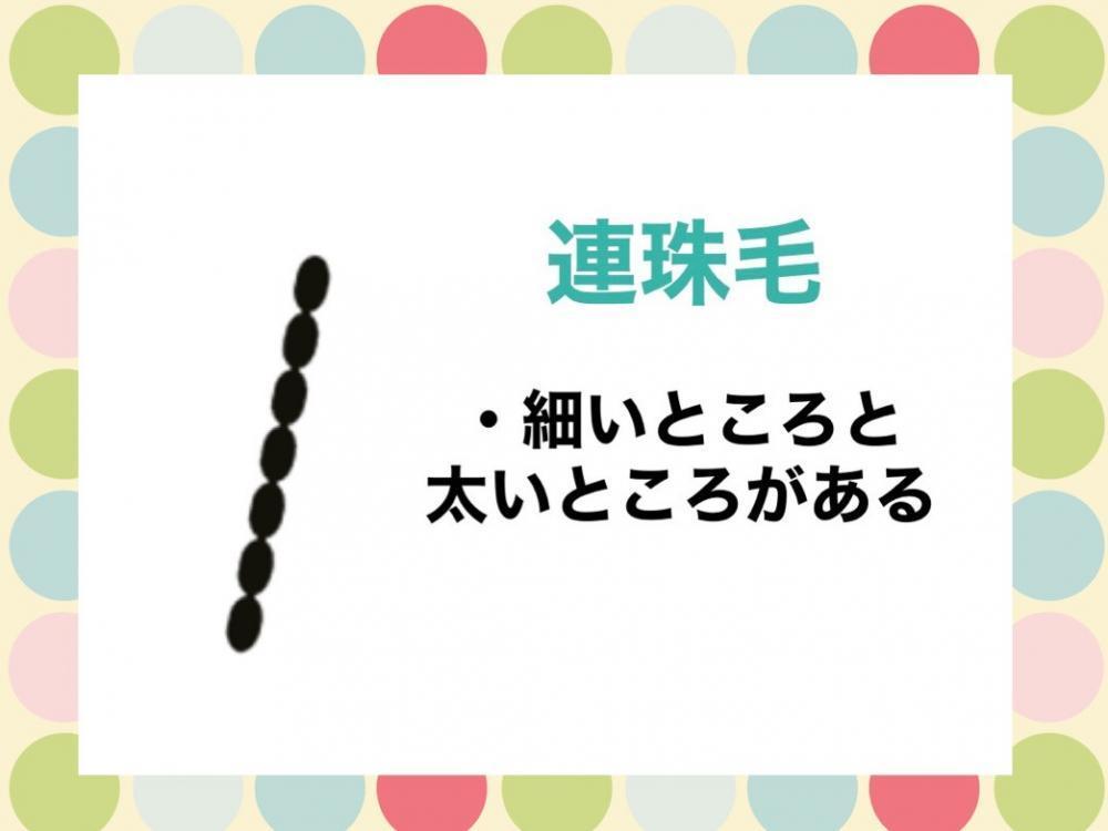 くせ毛の種類④連珠毛