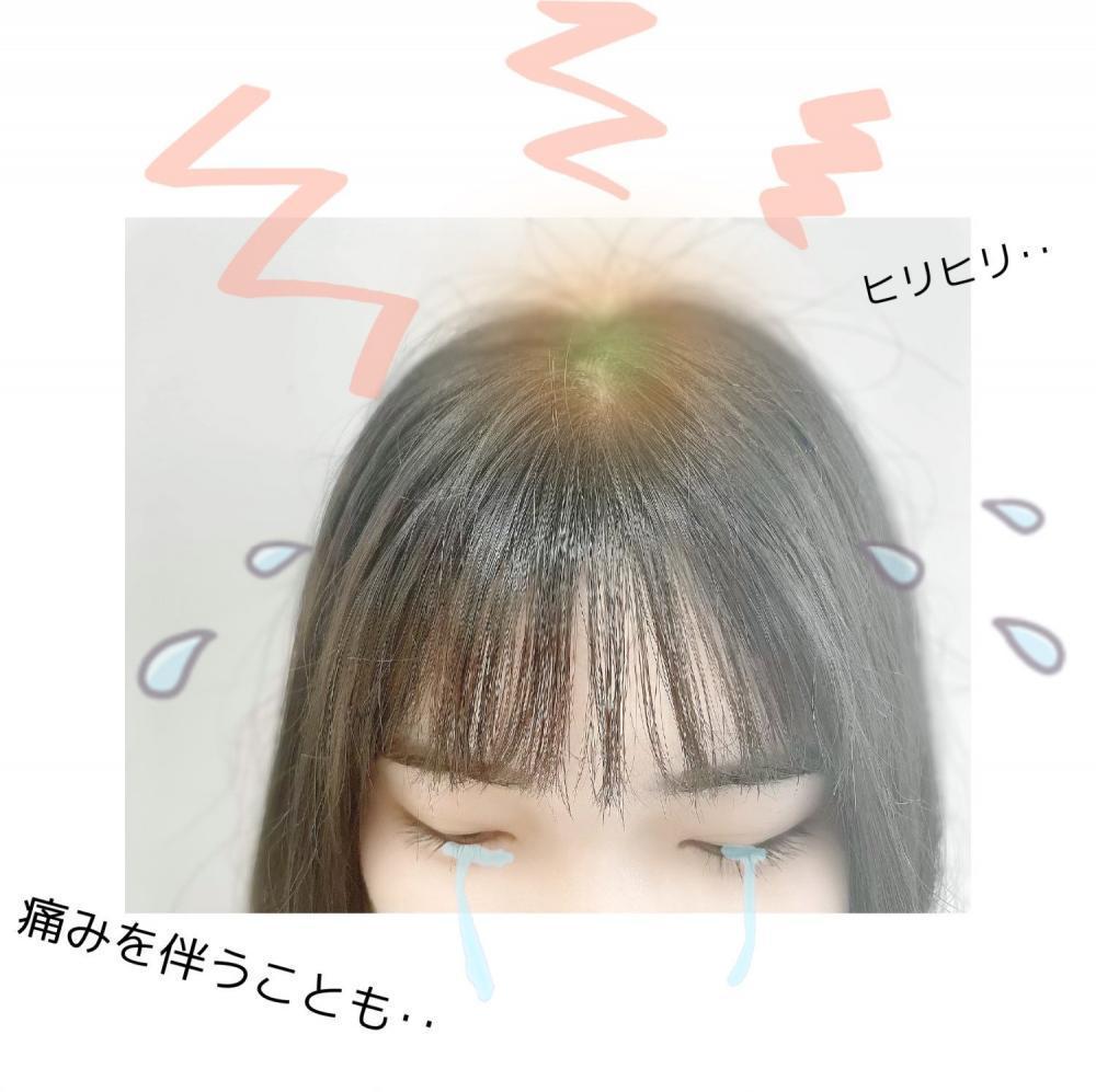 ★頭皮が日焼けをすると‥
