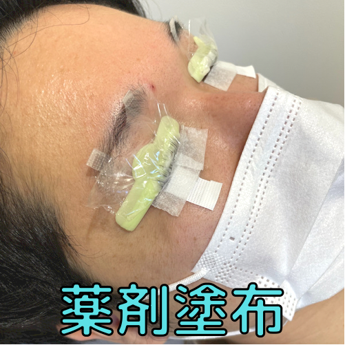 ロッド装着&薬剤塗布