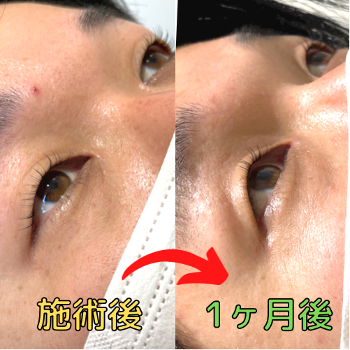 まつ毛パーマをかけてから約1ヶ月後の状態