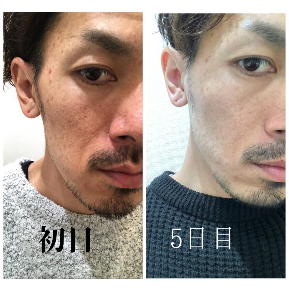 【ほうれい線】は消えるのか？