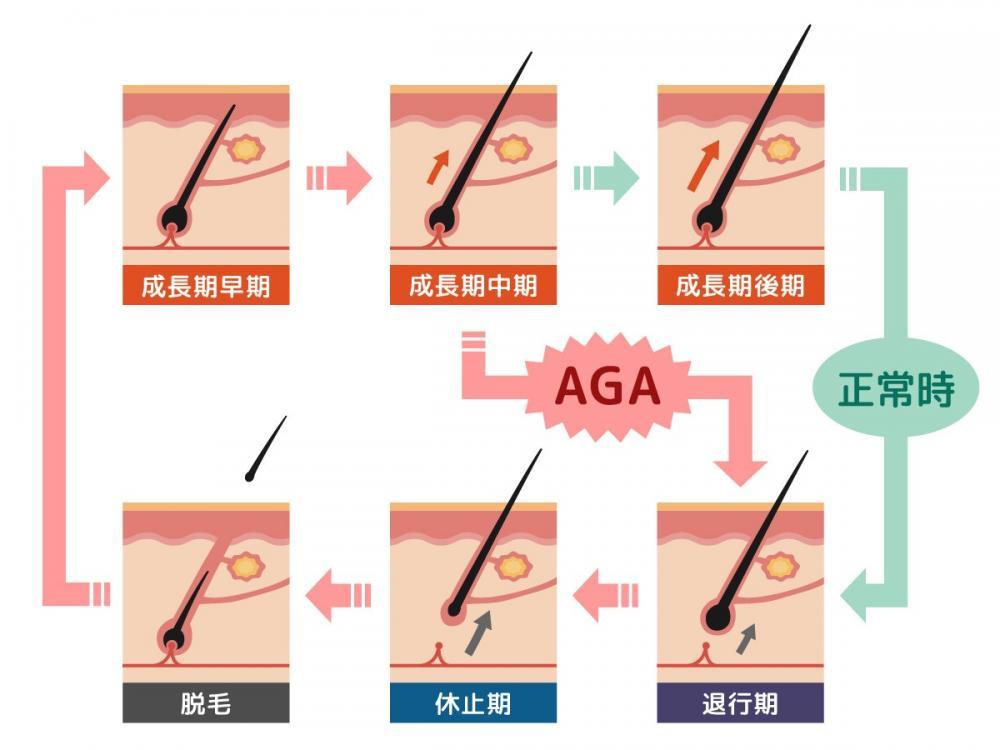 AGAのヘアサイクルとは