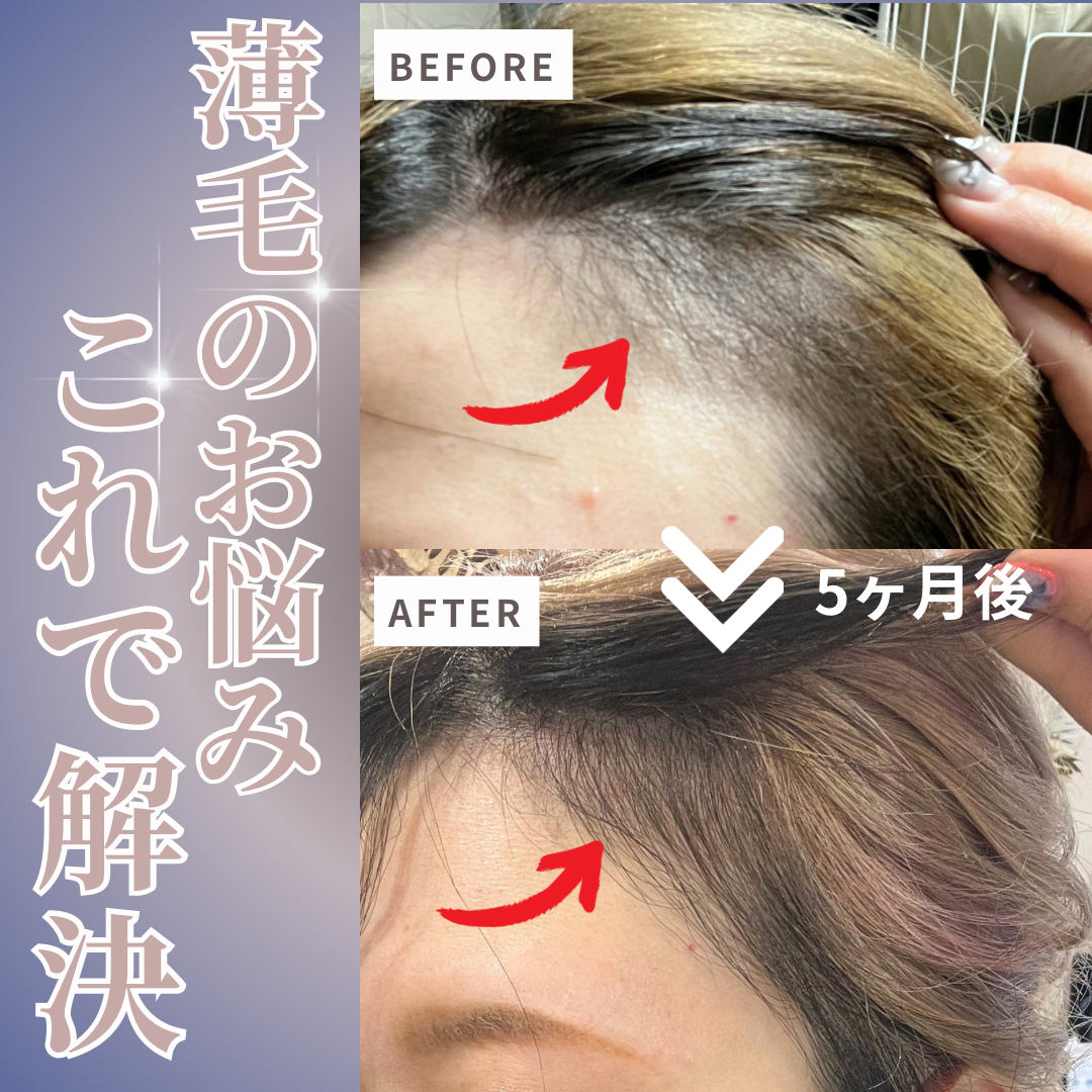 【薄毛にお悩みのお客様に朗報】プレセディア付きハッピーバックのご紹介