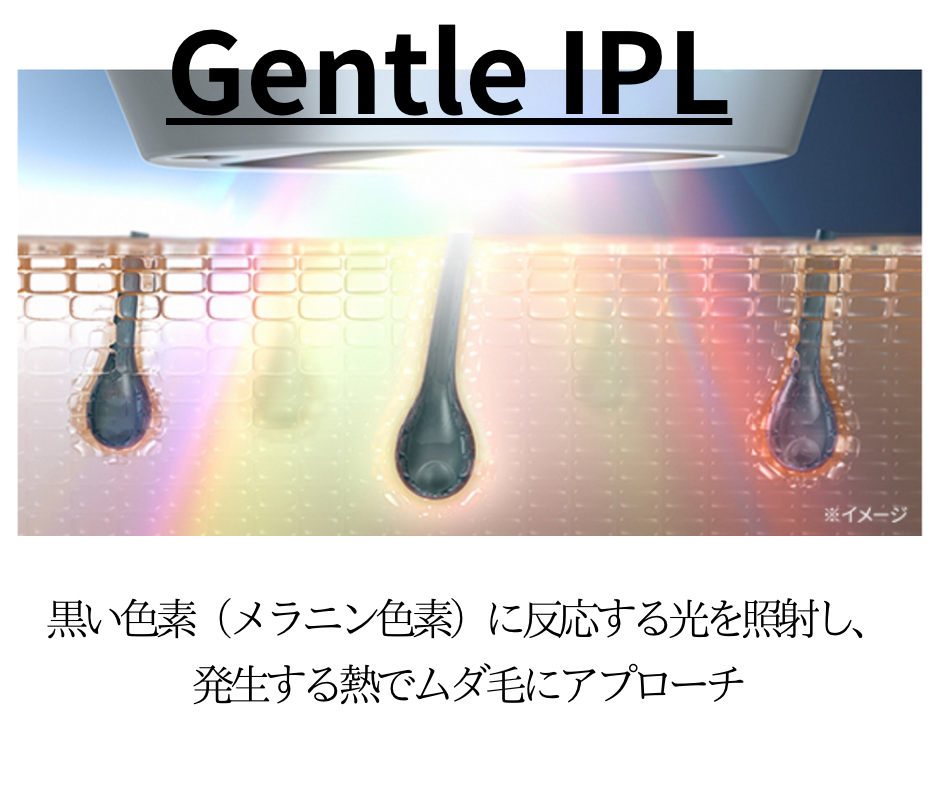 Gentle 　IPLという名の仕上がりと肌への優しさ