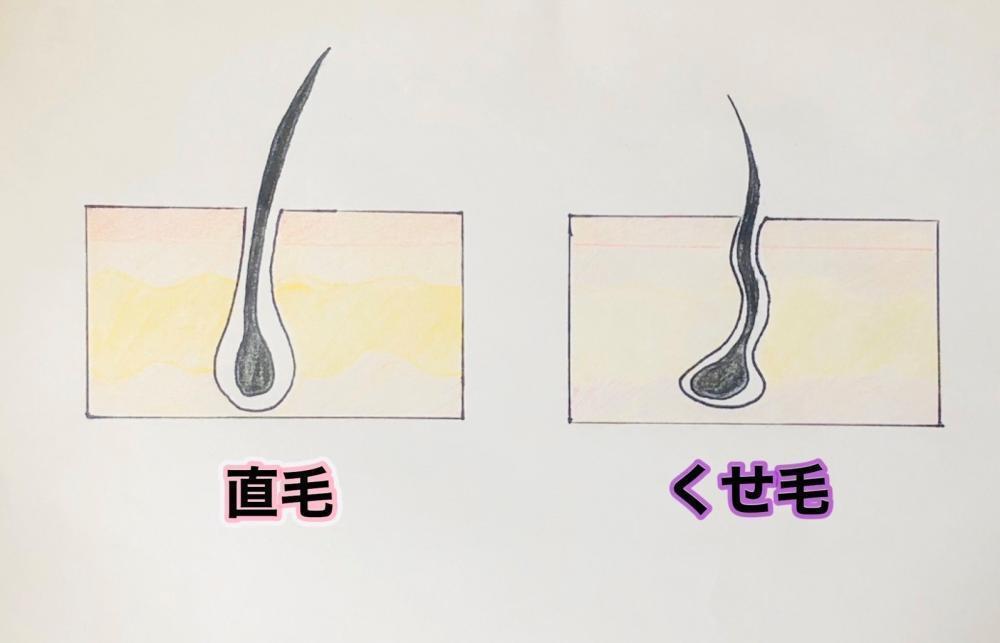 【毛穴の曲がり】