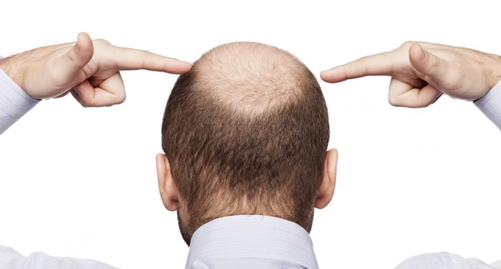 ヘアーサイクルを知って薄毛に別れを告げましょう